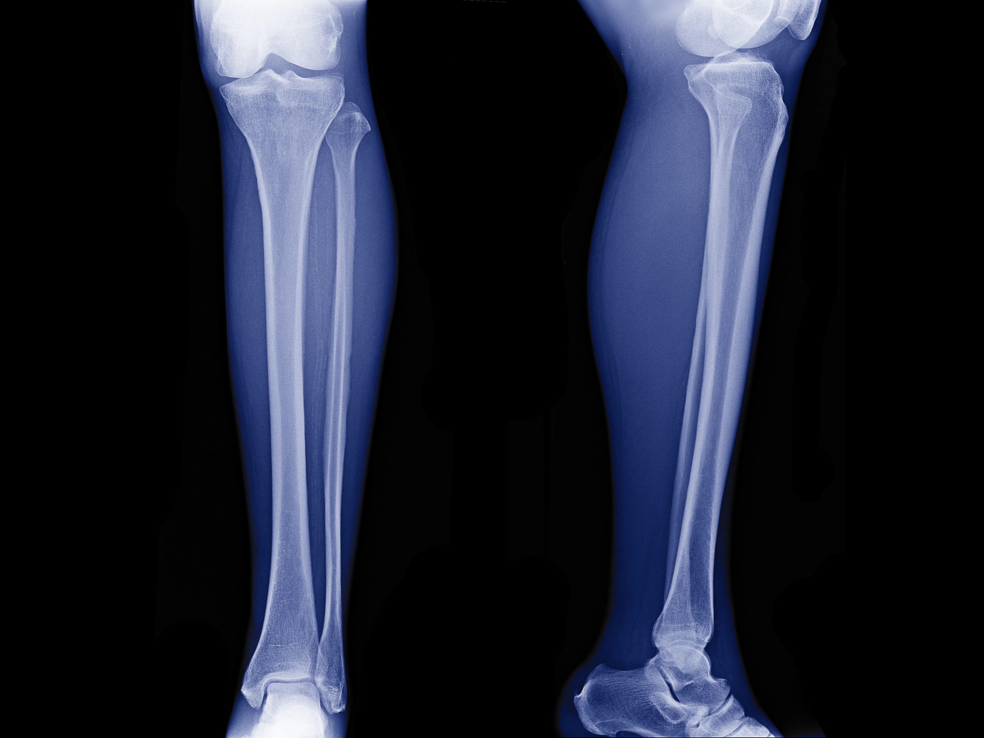 Zwei Beine als Röntgenbild